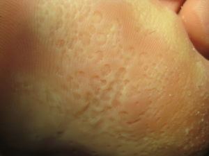 HIPERHIDROSIS