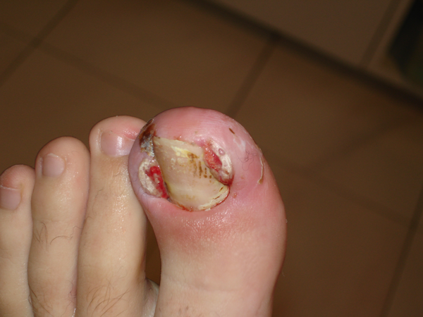Ongle incarné