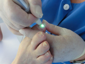 Centre Podomedic - Laser onicomicosis