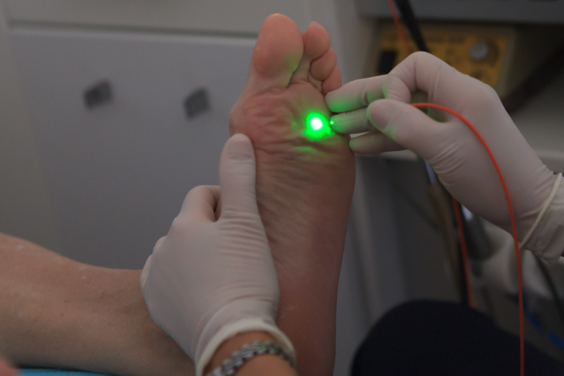 Laser Verrugas