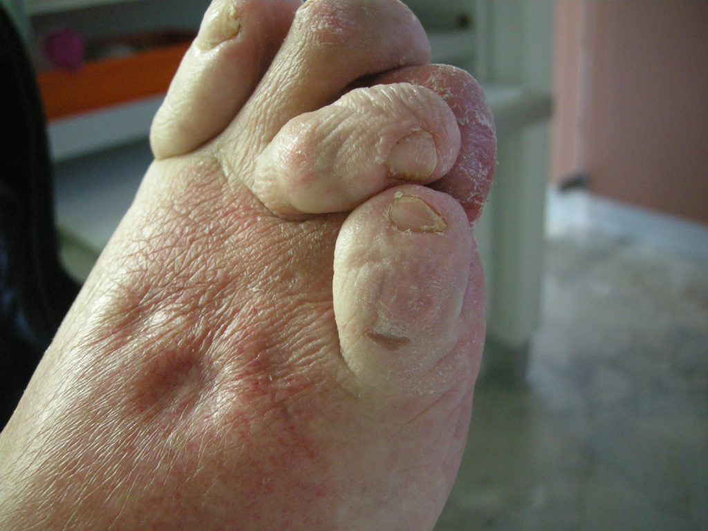 ARTRITIS
