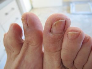 Chirurgische Behandlung eingewachsener Nägel