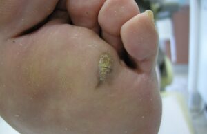 Soins des pieds en été